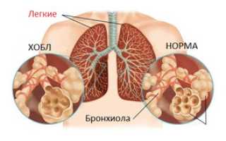 Что это такое – обструкция легких: классификация и лечение