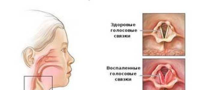 Чем лечить ларингит у взрослых?