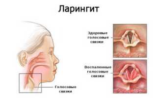 Как определить, ларингит заразен или нет?