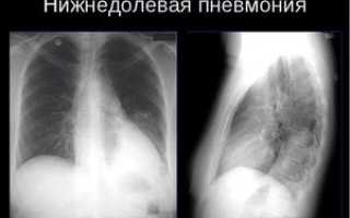 Правосторонняя нижнедолевая и верхнедолевая пневмония