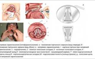 Что представляет собой прямая и непрямая ларингоскопия гортани