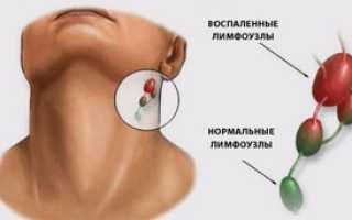 Что такое хронический тонзиллит и каковы его симптомы?