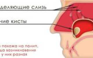 Киста в верхнечелюстной пазухе