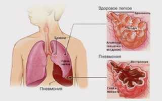 Двухсторонняя пневмония: как вылечить воспаление легких?
